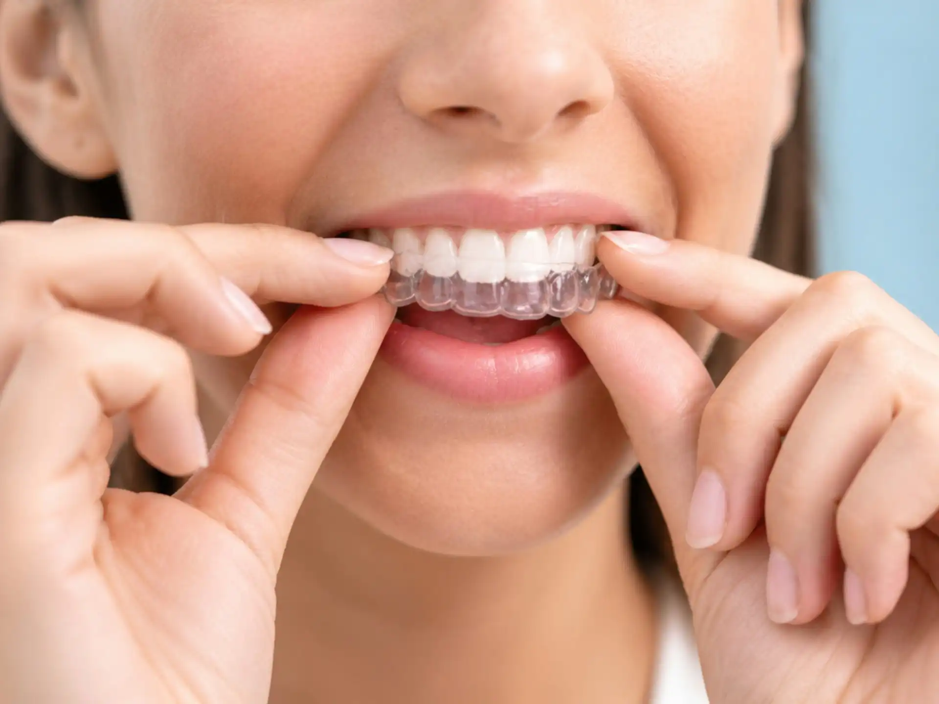 Invisalign in Surbiton for Busy Adults: Cost, Timeline and Mild Crowding