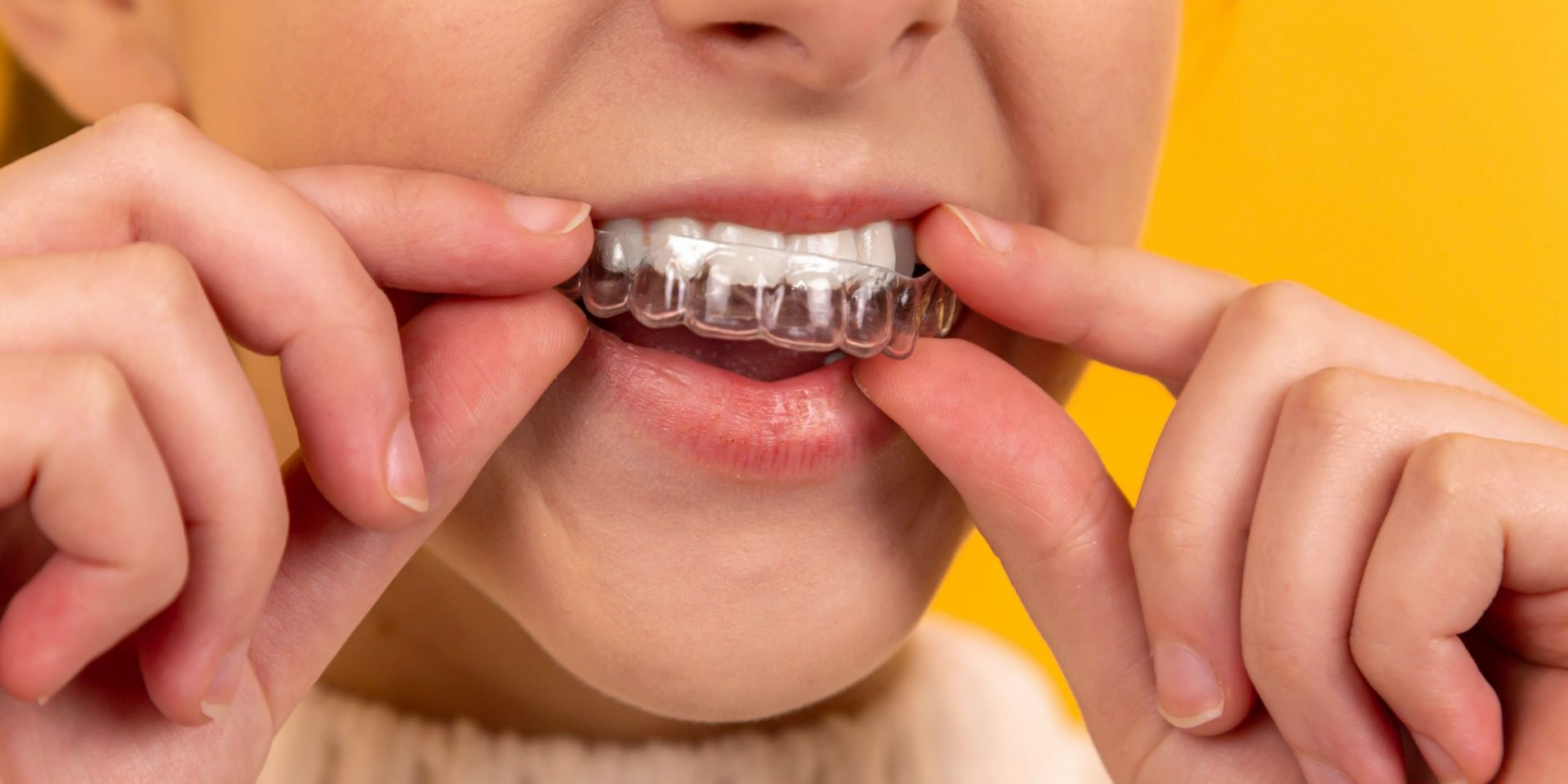 Train Tracks vs Invisalign: Which is Better?
