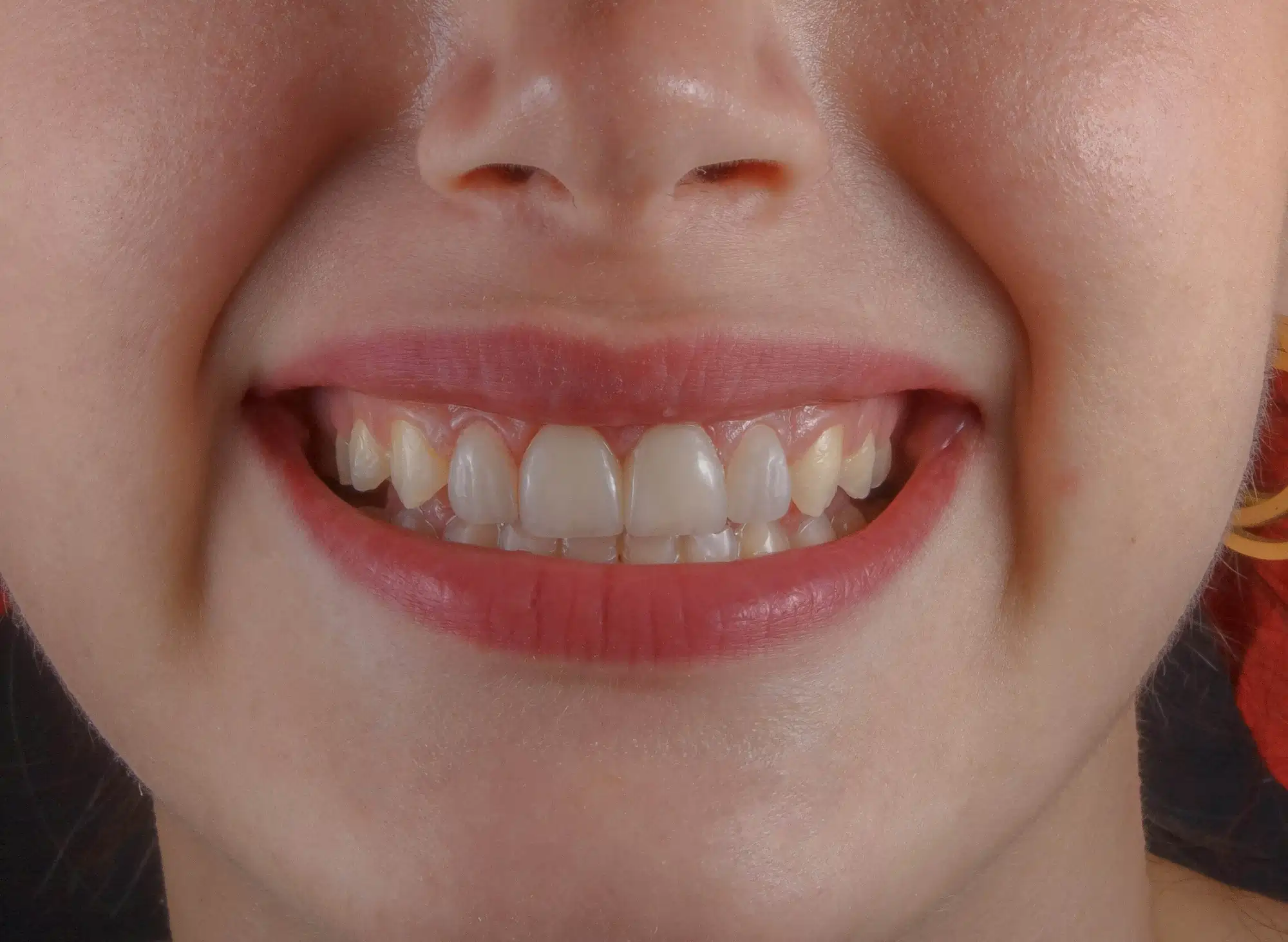 Example of a close-up of teeth smiling photo