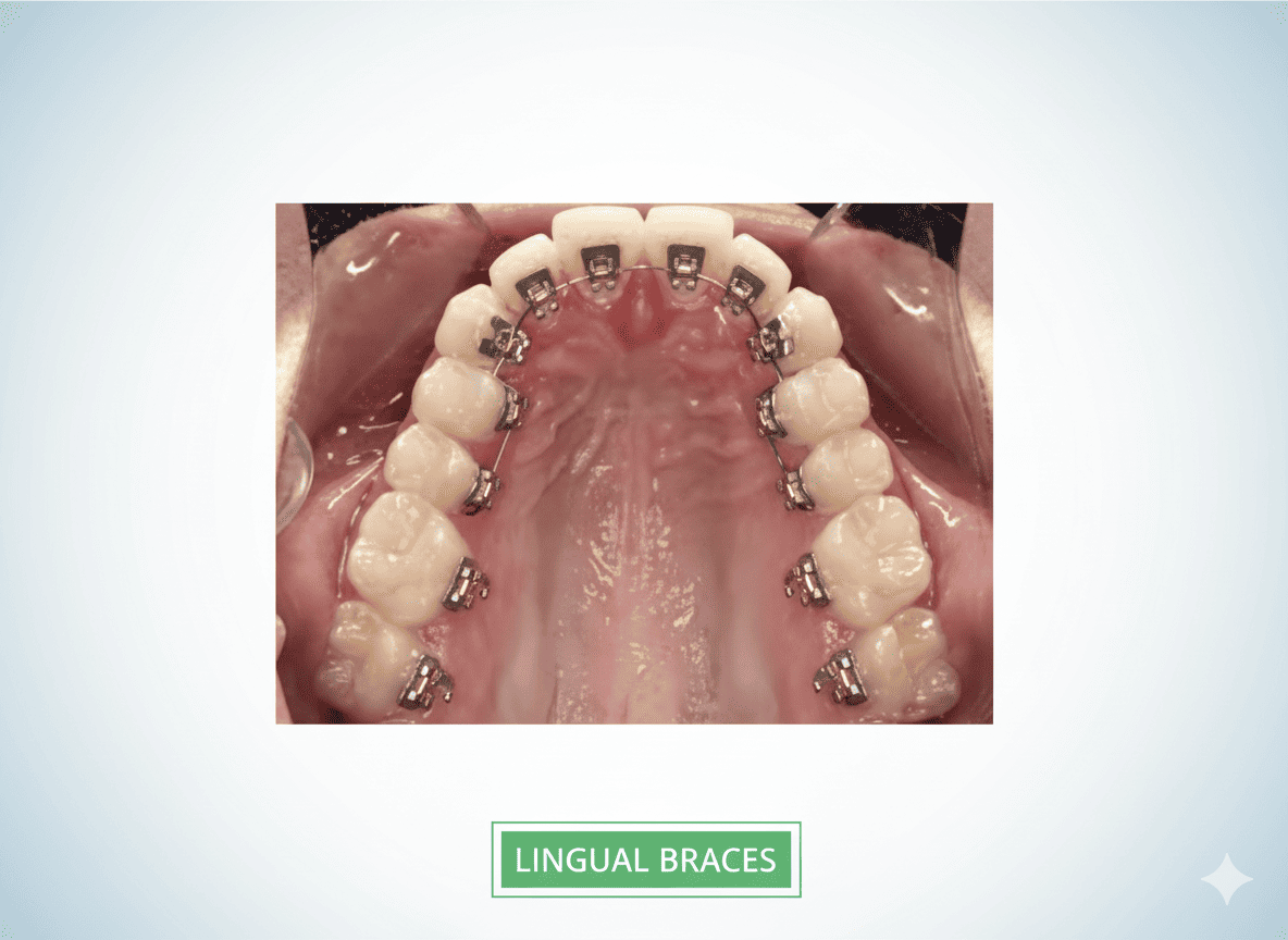 Lingual Braces